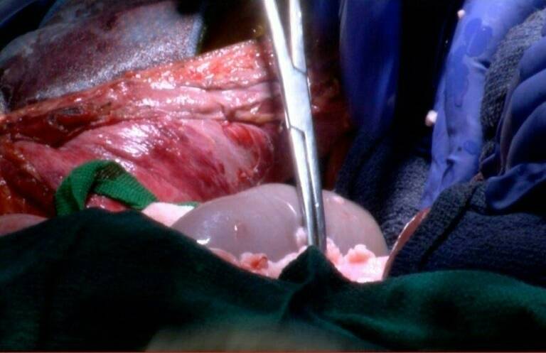 Health,US,transplant,kidney,pig,health