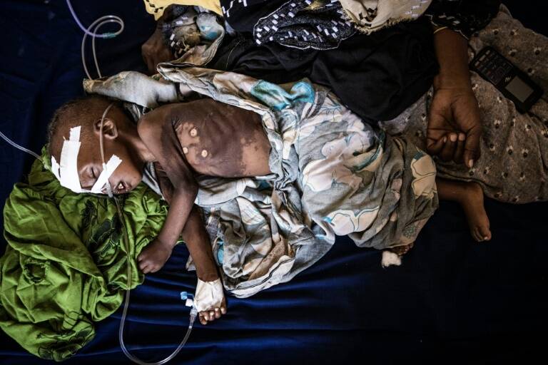 Somalia - hambruna - sequía - niños - hospital