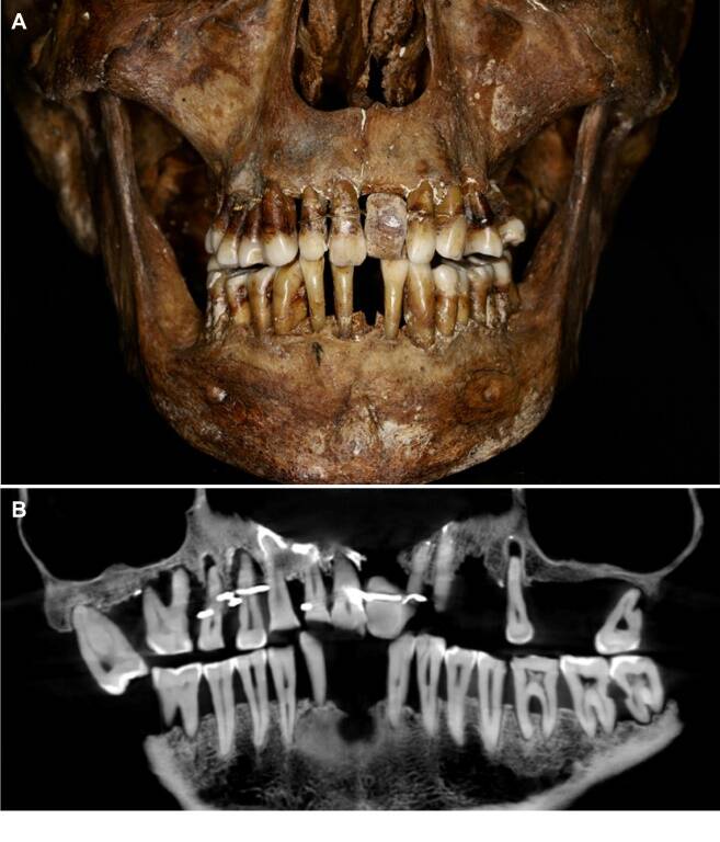 archéologie,anthropologie,histoire,maladie